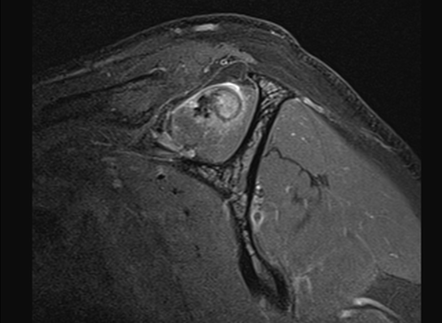 Figure 4 for case Massive interstitial delamination of Supraspinatus with retraction